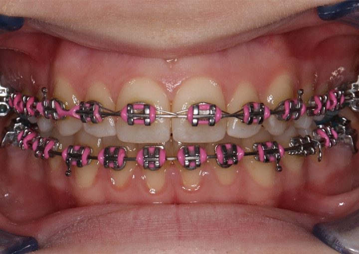 Bielenie zubov počas ortodontického ošetrenia a jeho vplyv na pevnosť spoja