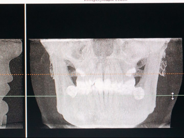 Využitie CBCT v hodnotení apikálnej resorpcie koreňov po ortodontickej liečbe