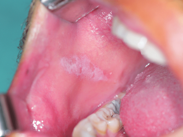Diagnostika bielych plôch v dutine ústnej