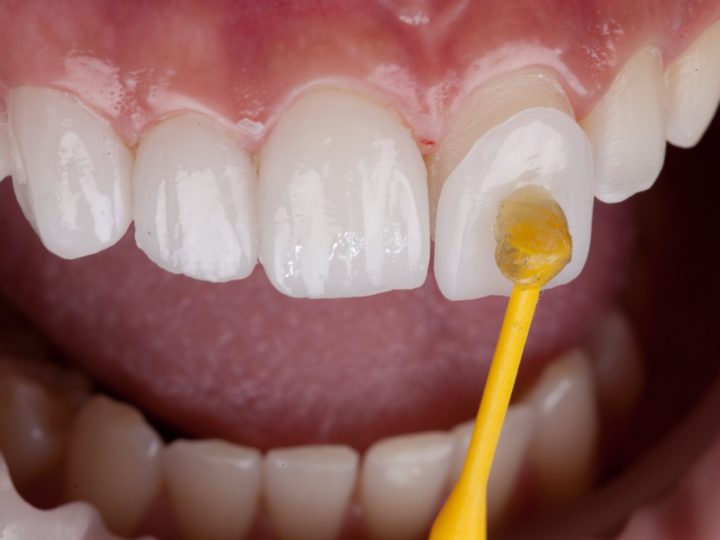 Úspešnosť zubných faziet v závislosti od preparácie a typu materiálu