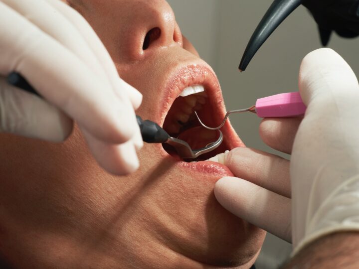 Červené lézie v dutine ústnej