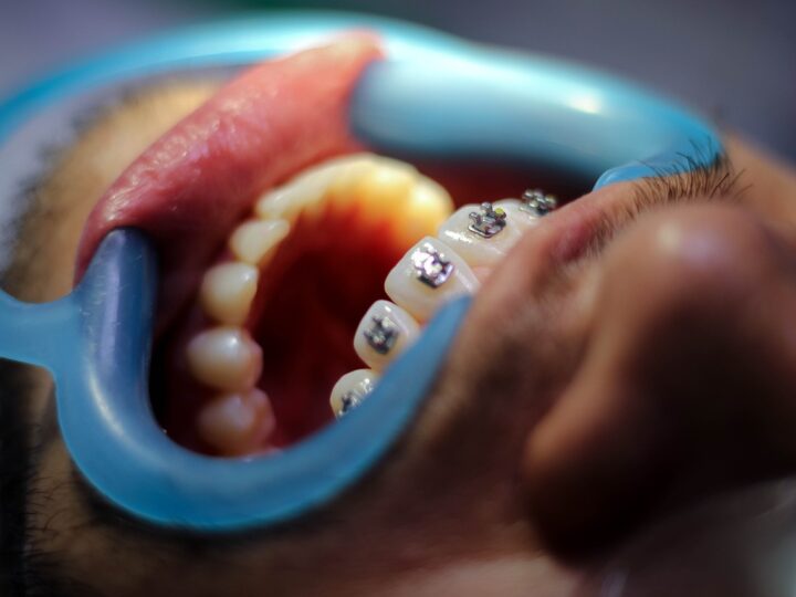 Vplyv ortodontickej liečby na profil tváre v kombinácii s ortognátnou chirurgiou alebo bez nej