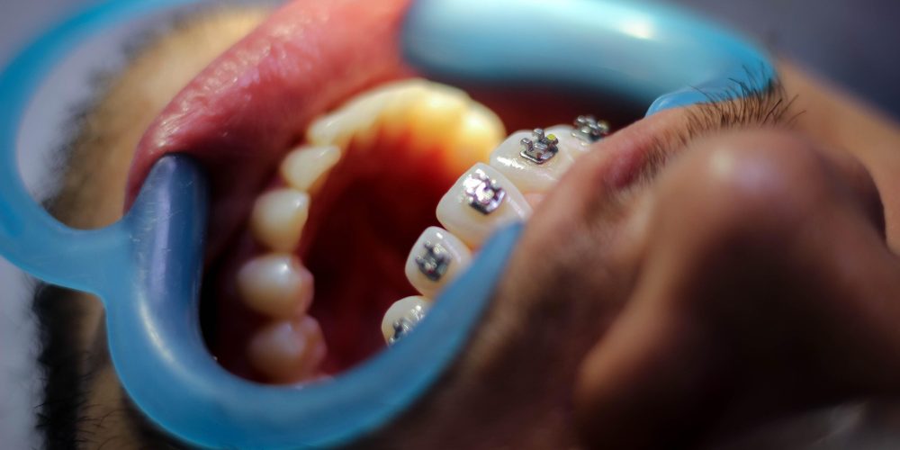 alejourbandj-orthodontics-5764087_1920