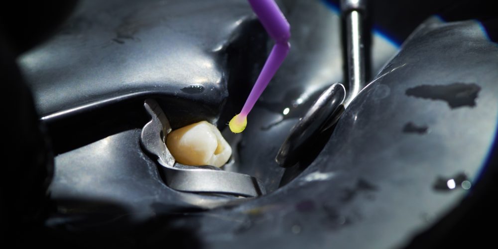 Closeup of fixing a tooth using a black rubber dam and dental instruments.