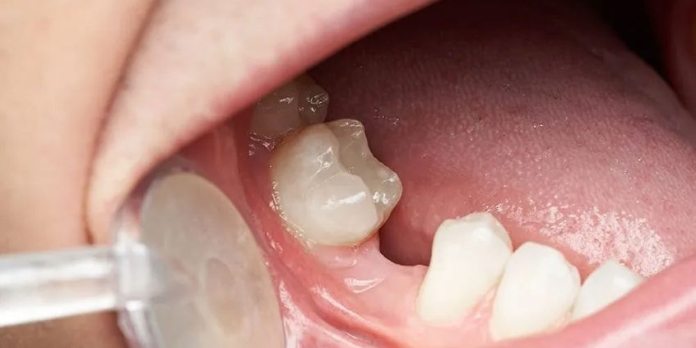 is-replacing-a-lost-tooth-with-an-implant-really-that-urgent