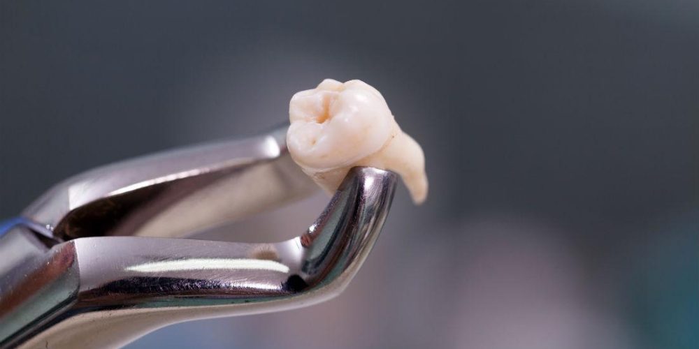 wisdom-tooth_2
